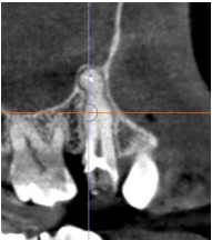 Challenging Management of Two Broken Instrument in a Severely Curved Canal: A Case Report